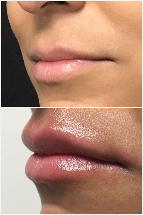 Pin By Khrom Dermatology And Aesthetics On Dermal Fillers Lip