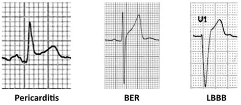 If st elevation shows a typical coved or saddle shaped pattern in v1v3 in the presence of complete or incomplete rbbb it is wise to consider brugada syndrome which is common in asian population and is a common cause of idiopathic ventricular fibrillation and sudden death (see next section). The ST Segment | Segmentation, Cardiology nursing, Ekg