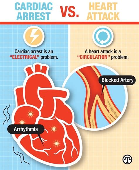 Cardiac Arrest Vs Heart Attack Vs Stroke Photos Idea