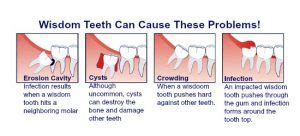 Things to keep in mind after molar removal. Extraction - Hill Park Dental