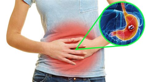 Gastritis Atrófica Y Metaplasia Intestinal Son Precursoras De Cáncer Gástrico