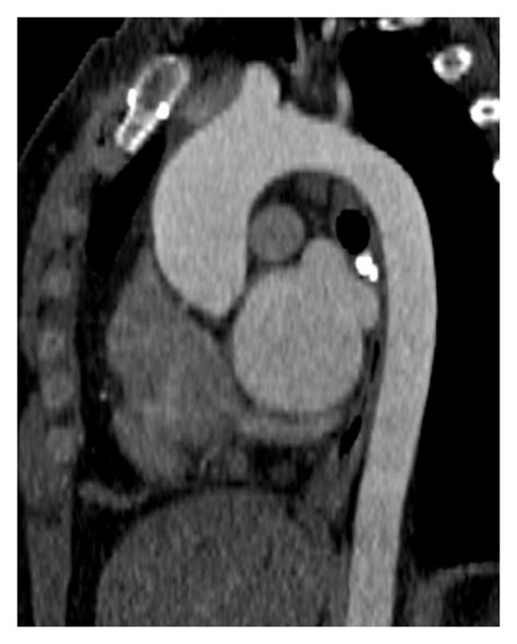 Ct And Mri In The Evaluation Of Thoracic Aortic Diseases