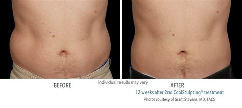 Coolsculpting Elite Before And After New Treatment And Better Results