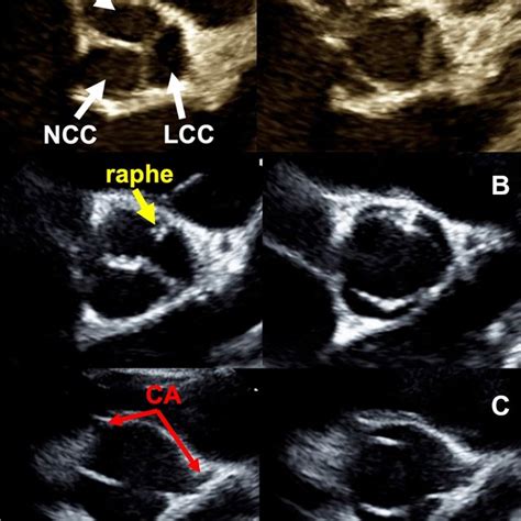 Tte Images Of A Bicuspid Aortic Valve Right Left Leaflet Fusion