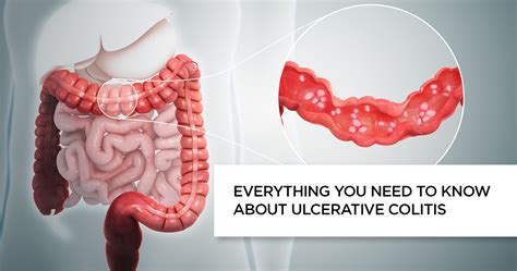 Ulcerative Colitis Symptoms Causes Lifestyle Changes Treatment