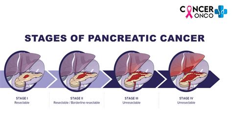Pancreatic Cancer Treatment And Its 5 Stages