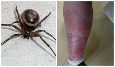 This Is What Happens When Youre Bitten By A Black Widow Spider Ladbible