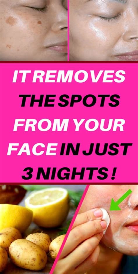 Simple Trick To Remove Brown Spots From Your Skin Brown Spots On Face