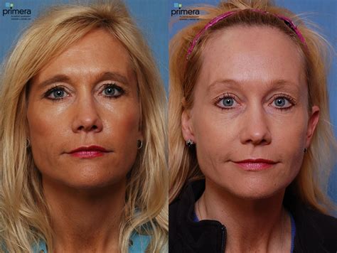 Endoscopic Forehead Lift Before And After Pictures Case Orlando