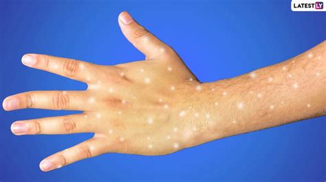 what are the white spots on your skin and should you be worried know more about idiopathic