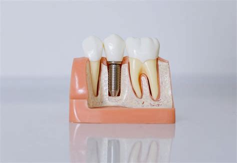 How Long Do Dental Implants Last Longevity Of Dental Implants