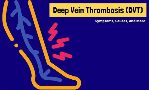 Deep Vein Thrombosis Dvt Symptoms Causes And More Resurchify