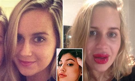 Australian Woman Buys A Lip Enhancer Online And The Results Are Not