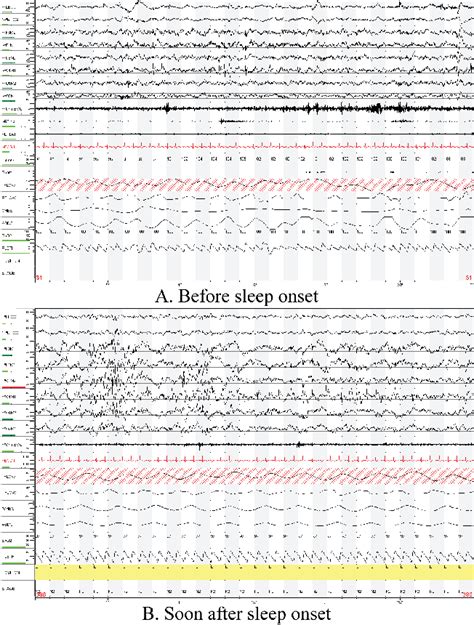 Four Year Old Girl With Abnormal Eeg On Routine Overnight Polysomnogram