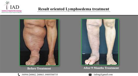 Managing And Treating Lymphoedema Lymphoedema Integrative Medicine