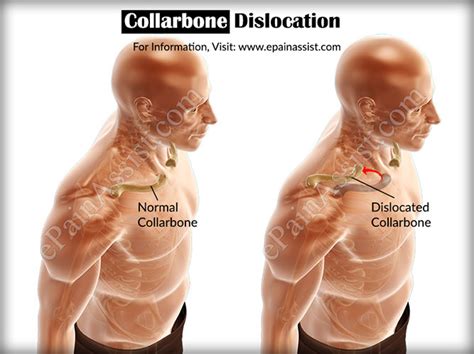 Collarbone Dislocationcausessymptomstreatmentdiagnosis