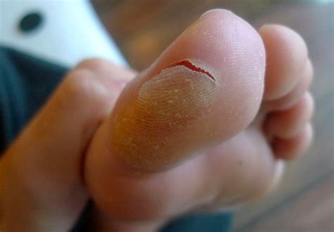 Blisters Perform Podiatry