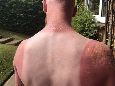 Worst I Ve Ever Seen Man Posts Images Of Horrific Sun Burn Photos