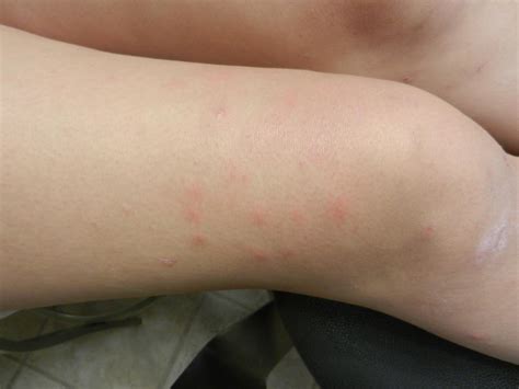 Pimples On Legs Causes And Treatment
