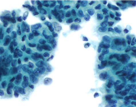 Cytology From One Fna Showed A Moderately Differentiated Ductal