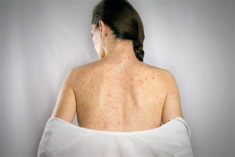 Whats The Most Effective Way To Treat Shingles Can It Be Done