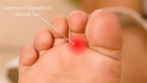 Capsulitis Of The Second Toe Symptoms Causes And Treatment