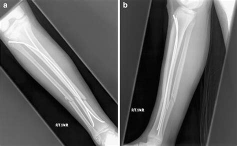Titanium Elastic Nails For Pediatric Tibial Shaft Fractures Wudbhav N