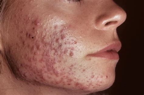 30 Azelaic Acid Peel Reduces Sebum Secretion Lesions In Women With Facial Acne Dermatology