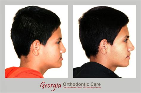 Georgia Orthodontic Care Lawrenceville And Norcross Ga December 2014
