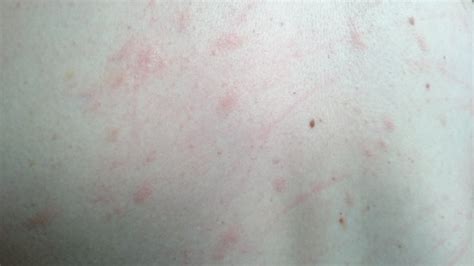 Itchy Red Bumps On Stomach And Backwhat Are These Page 2 Babycenter