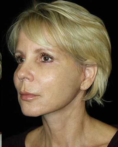 Patient 11580 Facelift Before And After Photos San Diego Ca Plastic Surgery Gallery Dr