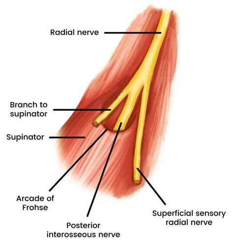 Radial Tunnel Syndrome — Chiroup