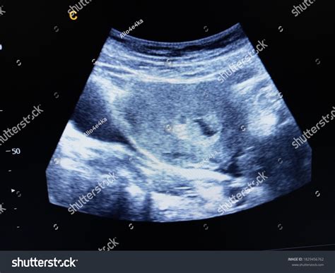 Intra Uterine Hematoma Pregnancy Gestational Sac Stock Photo 1829456762