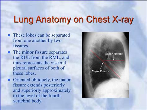 Normal X Ray Chest Findings Normal Chest X Ray Anatomy Tutorial