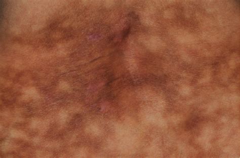64 Year Old Female With Asymptomatic Rash On Lower Back The Doctors