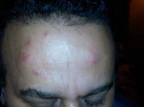 Bed Bug Bites On Forehead And Face Picture Of Chariot Inn Glendale