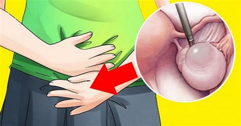 One of the best ways to shrink and dissolve ovarian cysts naturally is to use a castor oil pack, by soaking a flannel cloth in. 12 Herbs To Shrink Ovarian Cysts Naturally - Dr. Vikram's ...