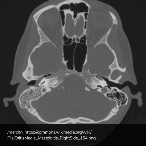 Malignant Otitis Externa Radiology