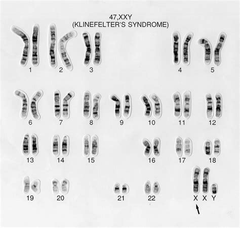 Klinefelter S Syndrome Karyotype Xxy Wellcome Collection