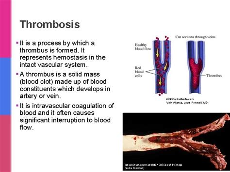 Thromboembolism Sufia Husain Associate Professor Pathology Department