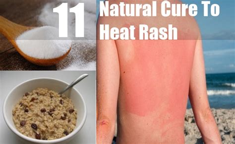 Top 11 Natural Cures For Heat Rash How To Cure Heat Rash Naturally