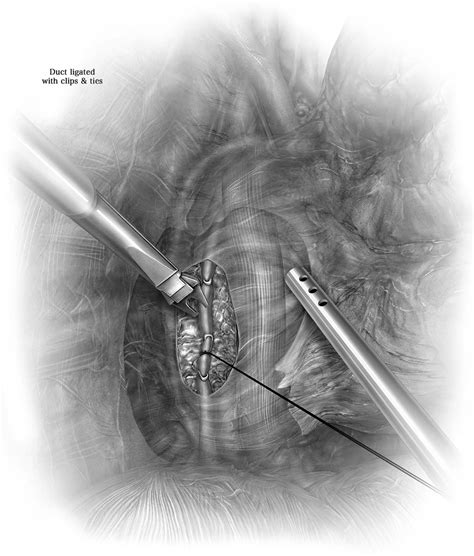 Thoracic Duct Ligation Right Video Assisted Thoracoscopic Surgery