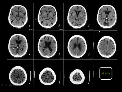 Normal Brain Old Age Atrophy How To Report Drmamdouh Mahfouz