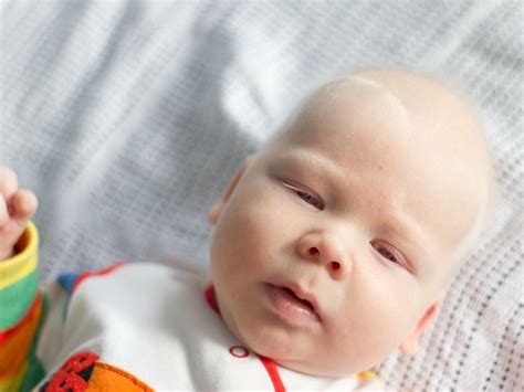 Albinizm Przyczyny Objawy Skutki Czy Bielactwo Wrodzone Mo Na Leczy