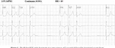Figure 1 From Transvenous Left Ventricular Epicardial Pacing In A