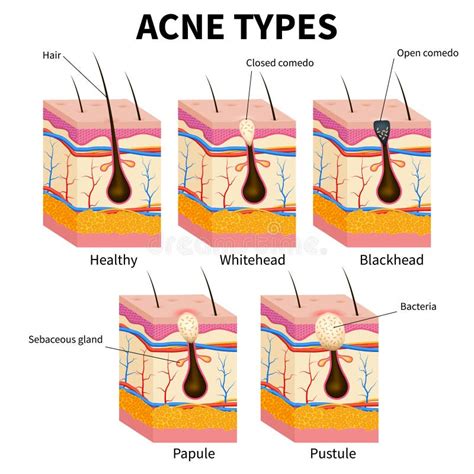List 98 Images Types Of Acne With Pictures Updated 122023