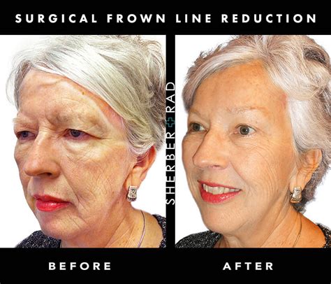 Frown Line Reduction Washington Dc Northern Va