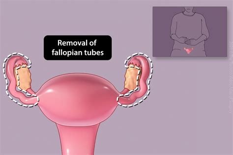 Patient Education Laparoscopy Procedure The Toronto Video Atlas Of Surgery