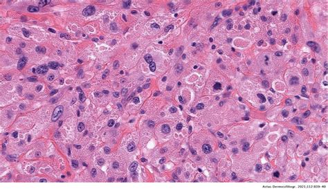 Primitive Polypoid Granular Cell Tumor Actas Dermo Sifiliográficas