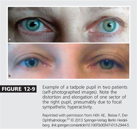 Diagnostic Approach To Pupillary Abnormalities Semantic Scholar